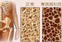 茄子视频官网APP下载茄子视频測試是通過茄子视频官网APP下载茄子视频檢測儀器測試你是否患有骨質疏鬆症